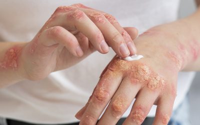 Padecimientos Médicos de la Piel en Temporada Invernal: Cuidado y Prevención