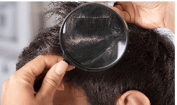 Shampoo antipiojos DCC